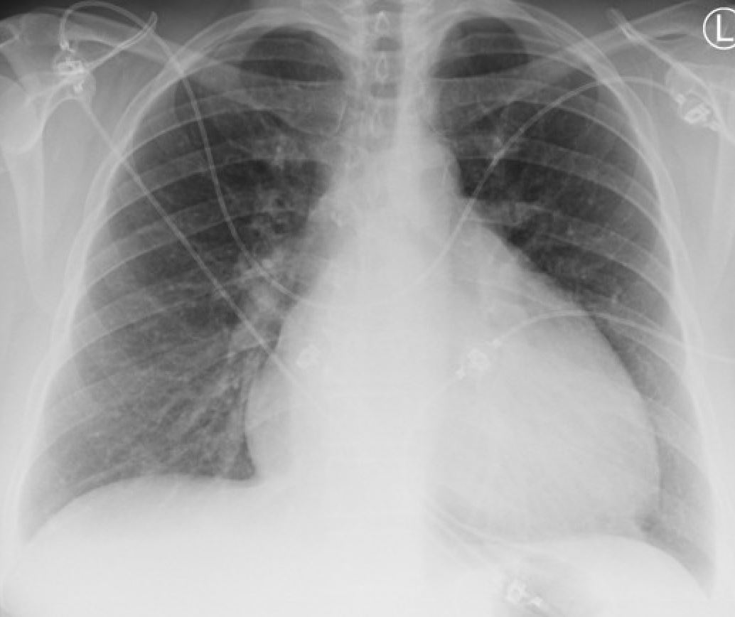 CXR.JPG