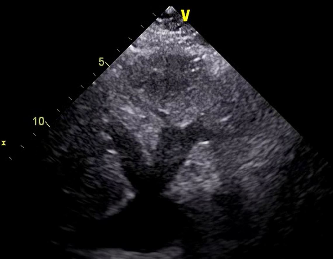 Engorged Hepatic Veins.JPG